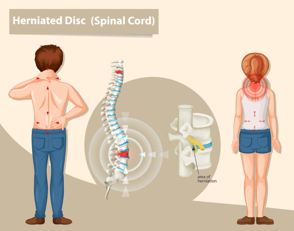 Slip Disc Treatment Without Surgery in Mumbai, India at Cure4Pain