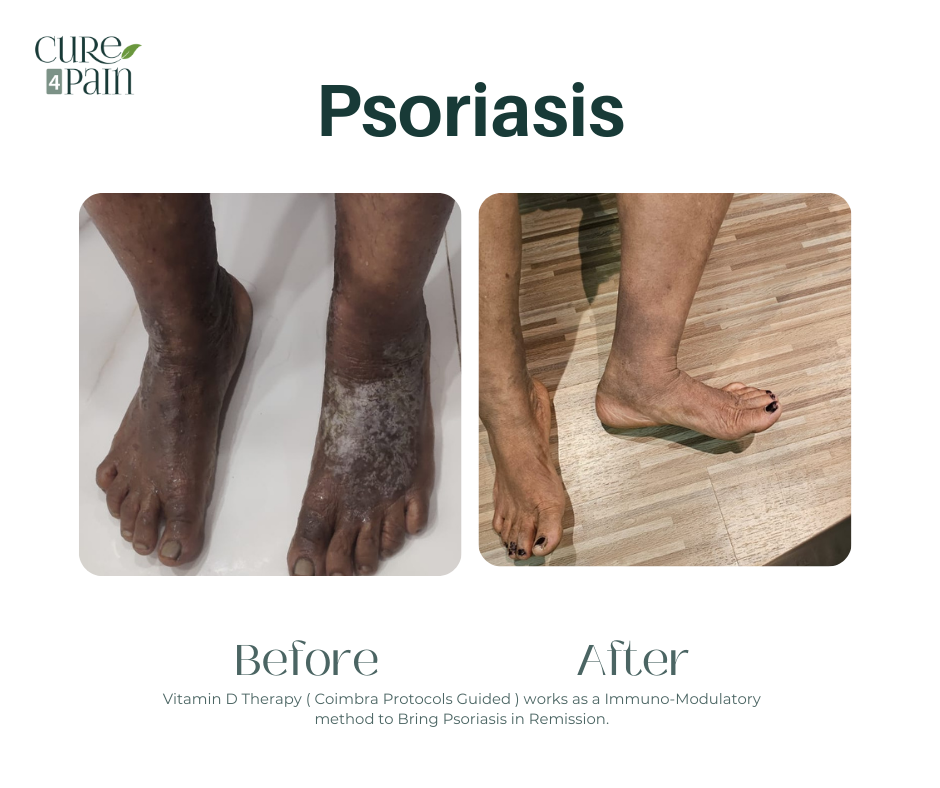 Psoriasis Treatment in Mumbai