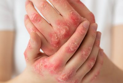 Hands affected by psoriasis, an autoimmune skin condition